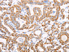 The image on the left is immunohistochemistry of paraffin-embedded Human thyroid cancer tissue using CSB-PA569426 (ATPIF1 Antibody) at dilution 1/50, on the right is treated with fusion protein. (Original magnification: ×200)