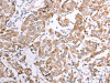 The image on the left is immunohistochemistry of paraffin-embedded Human breast cancer tissue using CSB-PA569426 (ATPIF1 Antibody) at dilution 1/50, on the right is treated with fusion protein. (Original magnification: ×200)