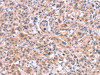 The image on the left is immunohistochemistry of paraffin-embedded Human esophagus cancer tissue using CSB-PA477402 (BMPR2 Antibody) at dilution 1/35, on the right is treated with fusion protein. (Original magnification: ×200)