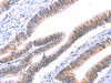 The image on the left is immunohistochemistry of paraffin-embedded Human colon cancer tissue using CSB-PA292051 (VWF Antibody) at dilution 1/50, on the right is treated with fusion protein. (Original magnification: ×200)