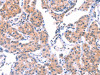 The image on the left is immunohistochemistry of paraffin-embedded Human lung cancer tissue using CSB-PA292051 (VWF Antibody) at dilution 1/50, on the right is treated with fusion protein. (Original magnification: ×200)