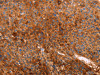 The image on the left is immunohistochemistry of paraffin-embedded Human liver cancer tissue using CSB-PA964049 (GC Antibody) at dilution 1/40, on the right is treated with fusion protein. (Original magnification: ×200)