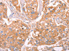 The image on the left is immunohistochemistry of paraffin-embedded Human breast cancer tissue using CSB-PA964049 (GC Antibody) at dilution 1/40, on the right is treated with fusion protein. (Original magnification: ×200)