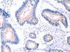 The image on the left is immunohistochemistry of paraffin-embedded Human colon cancer tissue using CSB-PA928876 (AADAC Antibody) at dilution 1/30, on the right is treated with fusion protein. (Original magnification: ×200)