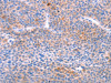 The image on the left is immunohistochemistry of paraffin-embedded Human liver cancer tissue using CSB-PA928876 (AADAC Antibody) at dilution 1/30, on the right is treated with fusion protein. (Original magnification: ×200)