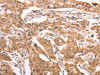 The image on the left is immunohistochemistry of paraffin-embedded Human lung cancer tissue using CSB-PA919003 (AASDHPPT Antibody) at dilution 1/30, on the right is treated with fusion protein. (Original magnification: ×200)