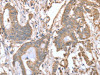 The image on the left is immunohistochemistry of paraffin-embedded Human colon cancer tissue using CSB-PA976738 (ABCB6 Antibody) at dilution 1/15, on the right is treated with fusion protein. (Original magnification: ×200)