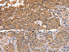 The image on the left is immunohistochemistry of paraffin-embedded Human lung cancer tissue using CSB-PA976738 (ABCB6 Antibody) at dilution 1/15, on the right is treated with fusion protein. (Original magnification: ×200)