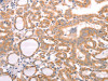 The image on the left is immunohistochemistry of paraffin-embedded Human thyroid cancer tissue using CSB-PA960487 (ABCF2 Antibody) at dilution 1/15, on the right is treated with fusion protein. (Original magnification: ×200)