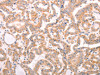 The image on the left is immunohistochemistry of paraffin-embedded Human thyroid cancer tissue using CSB-PA931399 (ABCF2 Antibody) at dilution 1/25, on the right is treated with fusion protein. (Original magnification: ×200)