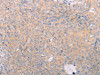 The image on the left is immunohistochemistry of paraffin-embedded Human cervical cancer tissue using CSB-PA595084 (ABCF3 Antibody) at dilution 1/30, on the right is treated with fusion protein. (Original magnification: ×200)