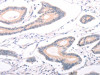 The image on the left is immunohistochemistry of paraffin-embedded Human colon cancer tissue using CSB-PA781903 (ABCF3 Antibody) at dilution 1/30, on the right is treated with fusion protein. (Original magnification: ×200)
