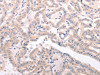 The image on the left is immunohistochemistry of paraffin-embedded Human thyroid cancer tissue using CSB-PA781903 (ABCF3 Antibody) at dilution 1/30, on the right is treated with fusion protein. (Original magnification: ×200)