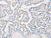 The image on the left is immunohistochemistry of paraffin-embedded Human gastric cancer tissue using CSB-PA051678 (ABHD1 Antibody) at dilution 1/15, on the right is treated with fusion protein. (Original magnification: ×200)