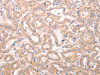 The image on the left is immunohistochemistry of paraffin-embedded Human thyroid cancer tissue using CSB-PA022733 (ABHD12 Antibody) at dilution 1/25, on the right is treated with fusion protein. (Original magnification: ×200)