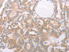 The image on the left is immunohistochemistry of paraffin-embedded Human liver cancer tissue using CSB-PA187767 (ABHD12 Antibody) at dilution 1/30, on the right is treated with fusion protein. (Original magnification: ×200)