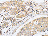 The image on the left is immunohistochemistry of paraffin-embedded Human breast cancer tissue using CSB-PA149552 (ABHD5 Antibody) at dilution 1/15, on the right is treated with fusion protein. (Original magnification: ×200)