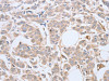 The image on the left is immunohistochemistry of paraffin-embedded Human breast cancer tissue using CSB-PA072974 (ABHD5 Antibody) at dilution 1/10, on the right is treated with fusion protein. (Original magnification: ×200)