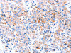 The image on the left is immunohistochemistry of paraffin-embedded Human lung cancer tissue using CSB-PA614749 (ACAA2 Antibody) at dilution 1/20, on the right is treated with fusion protein. (Original magnification: ×200)