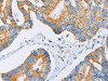 The image on the left is immunohistochemistry of paraffin-embedded Human colon cancer tissue using CSB-PA297340 (ACAA2 Antibody) at dilution 1/30, on the right is treated with fusion protein. (Original magnification: ×200)