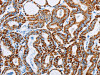 The image on the left is immunohistochemistry of paraffin-embedded Human thyroid cancer tissue using CSB-PA297340 (ACAA2 Antibody) at dilution 1/30, on the right is treated with fusion protein. (Original magnification: ×200)