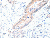 The image on the left is immunohistochemistry of paraffin-embedded Human colon cancer tissue using CSB-PA043583 (ACAD10 Antibody) at dilution 1/15, on the right is treated with fusion protein. (Original magnification: ×200)