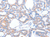 The image on the left is immunohistochemistry of paraffin-embedded Human thyroid cancer tissue using CSB-PA043583 (ACAD10 Antibody) at dilution 1/15, on the right is treated with fusion protein. (Original magnification: ×200)