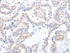 The image on the left is immunohistochemistry of paraffin-embedded Human thyroid cancer tissue using CSB-PA883300 (ACAD10 Antibody) at dilution 1/10, on the right is treated with fusion protein. (Original magnification: ×200)