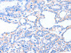 The image on the left is immunohistochemistry of paraffin-embedded Human thyroid cancer tissue using CSB-PA598870 (ACAD8 Antibody) at dilution 1/20, on the right is treated with fusion protein. (Original magnification: ×200)