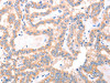 The image on the left is immunohistochemistry of paraffin-embedded Human thyroid cancer tissue using CSB-PA798115 (ACAD8 Antibody) at dilution 1/15, on the right is treated with fusion protein. (Original magnification: ×200)