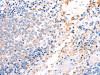The image on the left is immunohistochemistry of paraffin-embedded Human ovarian cancer tissue using CSB-PA055934 (ACAD9 Antibody) at dilution 1/15, on the right is treated with fusion protein. (Original magnification: ×200)