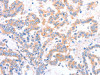 The image on the left is immunohistochemistry of paraffin-embedded Human thyroid cancer tissue using CSB-PA055934 (ACAD9 Antibody) at dilution 1/15, on the right is treated with fusion protein. (Original magnification: ×200)