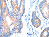 The image on the left is immunohistochemistry of paraffin-embedded Human colon cancer tissue using CSB-PA957686 (ACADS Antibody) at dilution 1/20, on the right is treated with fusion protein. (Original magnification: ×200)