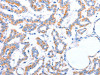 The image on the left is immunohistochemistry of paraffin-embedded Human thyroid cancer tissue using CSB-PA957686 (ACADS Antibody) at dilution 1/20, on the right is treated with fusion protein. (Original magnification: ×200)