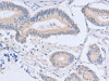 The image on the left is immunohistochemistry of paraffin-embedded Human colon cancer tissue using CSB-PA297536 (ACMSD Antibody) at dilution 1/15, on the right is treated with fusion protein. (Original magnification: ×200) The image on the left is immunohistochemistry of paraffin-embedded Human colon cancer tissue using CSB-PA297536 (ACMSD Antibody) at dilution 1/15, on the right is treated with fusion protein. (Original magnification: ×200)