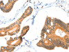 The image on the left is immunohistochemistry of paraffin-embedded Human colon cancer tissue using CSB-PA975419 (ACOX3 Antibody) at dilution 1/35, on the right is treated with fusion protein. (Original magnification: ×200)