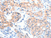 The image on the left is immunohistochemistry of paraffin-embedded Human lung cancer tissue using CSB-PA279017 (ACSM5 Antibody) at dilution 1/35, on the right is treated with fusion protein. (Original magnification: ×200)