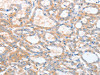 The image on the left is immunohistochemistry of paraffin-embedded Human thyroid cancer tissue using CSB-PA577006 (ACY3 Antibody) at dilution 1/25, on the right is treated with fusion protein. (Original magnification: ×200)