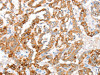 The image on the left is immunohistochemistry of paraffin-embedded Human thyroid cancer tissue using CSB-PA587551 (ACY3 Antibody) at dilution 1/35, on the right is treated with fusion protein. (Original magnification: ×200)