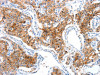 The image on the left is immunohistochemistry of paraffin-embedded Human lung cancer tissue using CSB-PA240615 (ADA Antibody) at dilution 1/15, on the right is treated with fusion protein. (Original magnification: ×200)