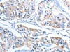 The image on the left is immunohistochemistry of paraffin-embedded Human breast cancer tissue using CSB-PA073477 (ADSL Antibody) at dilution 1/20, on the right is treated with fusion protein. (Original magnification: ×200)