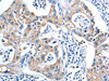 The image on the left is immunohistochemistry of paraffin-embedded Human lung cancer tissue using CSB-PA073477 (ADSL Antibody) at dilution 1/20, on the right is treated with fusion protein. (Original magnification: ×200)