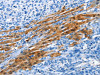 The image on the left is immunohistochemistry of paraffin-embedded Human liver cancer tissue using CSB-PA916372 (ADH4 Antibody) at dilution 1/35, on the right is treated with fusion protein. (Original magnification: ×200)