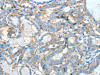 The image on the left is immunohistochemistry of paraffin-embedded Human thyroid cancer tissue using CSB-PA205525 (AGBL3 Antibody) at dilution 1/45, on the right is treated with fusion protein. (Original magnification: ×200)