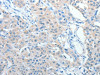 The image on the left is immunohistochemistry of paraffin-embedded Human lung cancer tissue using CSB-PA280169 (AKAP9 Antibody) at dilution 1/10, on the right is treated with fusion protein. (Original magnification: ×200)