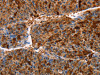 The image on the left is immunohistochemistry of paraffin-embedded Human liver cancer tissue using CSB-PA918257 (AKR1B10 Antibody) at dilution 1/30, on the right is treated with fusion protein. (Original magnification: ×200)