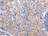 The image on the left is immunohistochemistry of paraffin-embedded Human lung cancer tissue using CSB-PA918257 (AKR1B10 Antibody) at dilution 1/30, on the right is treated with fusion protein. (Original magnification: ×200)