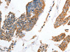 The image on the left is immunohistochemistry of paraffin-embedded Human colon cancer tissue using CSB-PA217516 (AKR1D1 Antibody) at dilution 1/35, on the right is treated with fusion protein. (Original magnification: ×200)