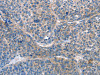 The image on the left is immunohistochemistry of paraffin-embedded Human liver cancer tissue using CSB-PA970433 (AKR1D1 Antibody) at dilution 1/25, on the right is treated with fusion protein. (Original magnification: ×200)