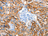 The image on the left is immunohistochemistry of paraffin-embedded Human esophagus cancer tissue using CSB-PA267569 (AOX1 Antibody) at dilution 1/65, on the right is treated with fusion protein. (Original magnification: ×200)